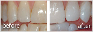 Teeth Whitening offers a brighter smile